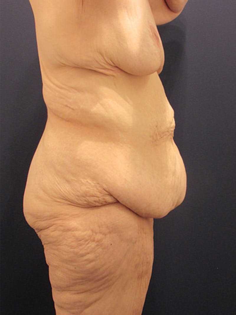 Massive Weight Loss Before & After