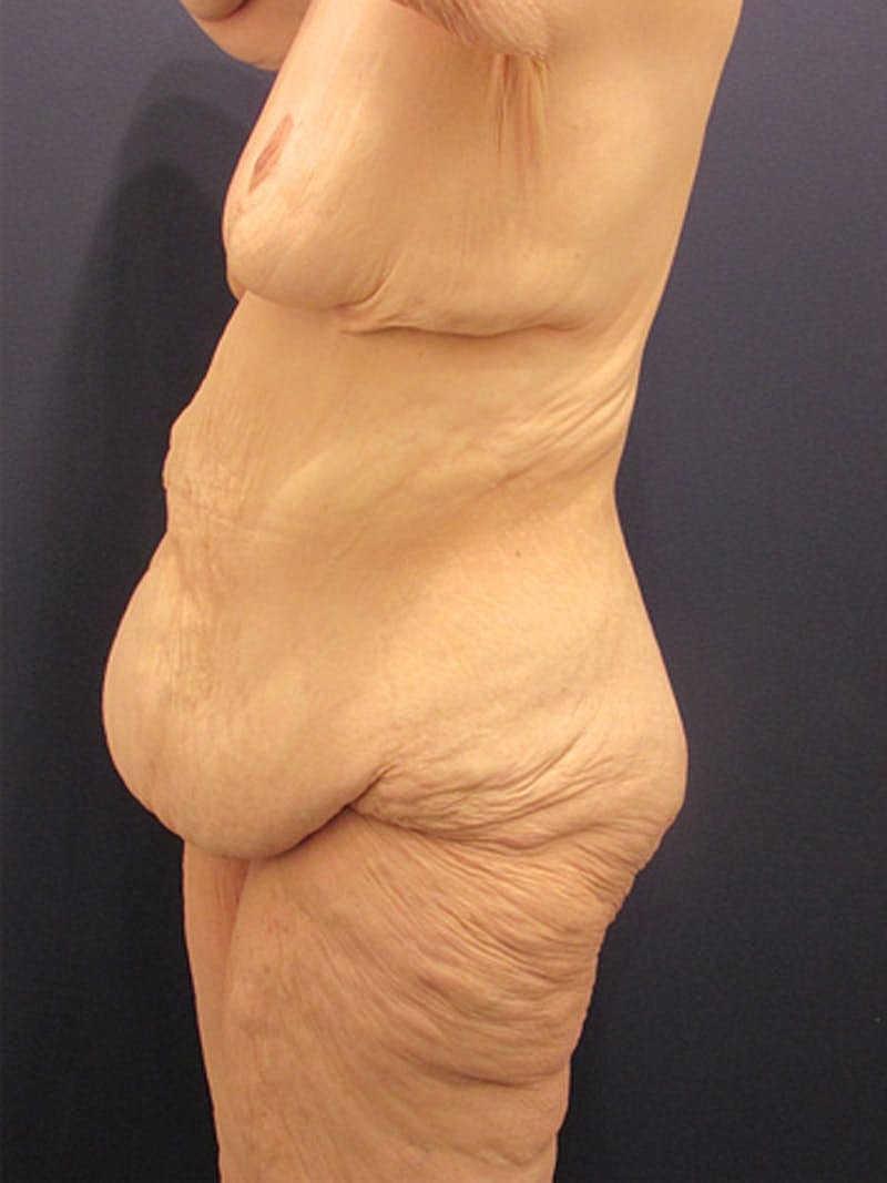 Massive Weight Loss Before & After