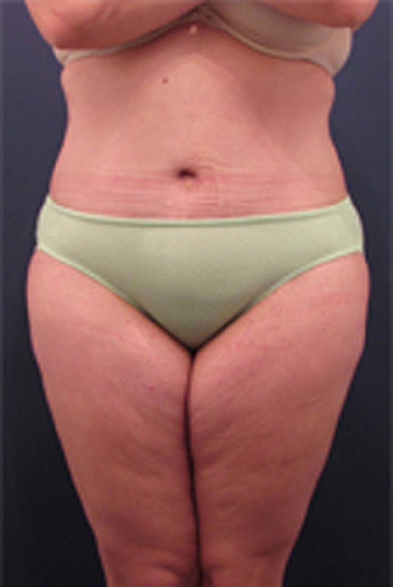 Massive Weight Loss Before & After