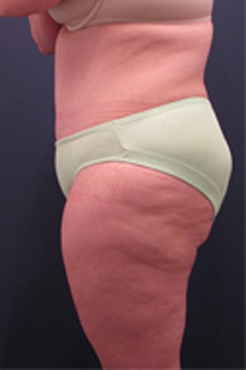 Massive Weight Loss Before & After