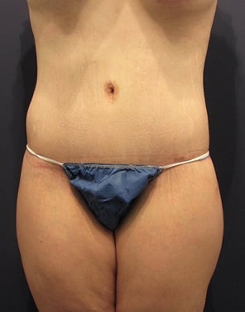 Massive Weight Loss Before & After