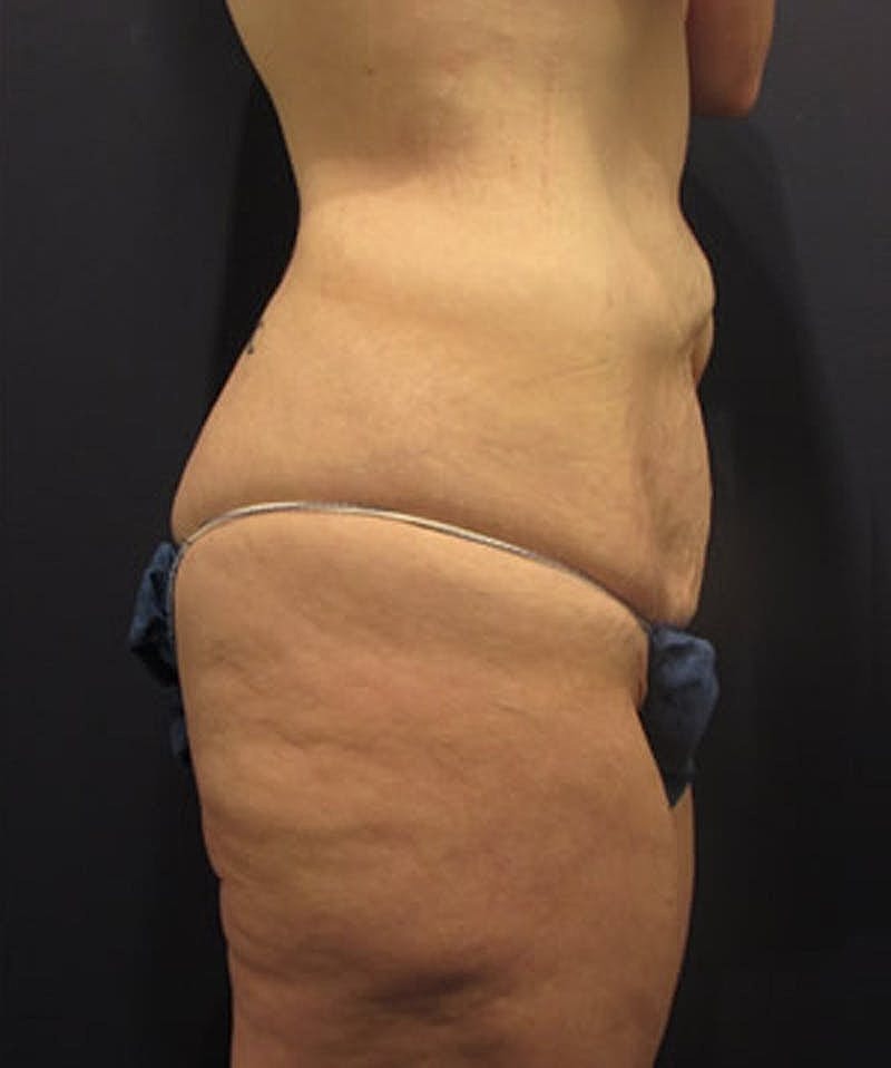 Massive Weight Loss Before & After