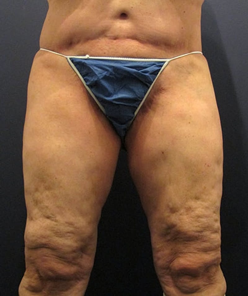 Massive Weight Loss Before & After