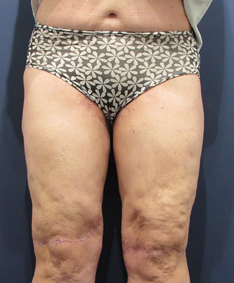 Massive Weight Loss Before & After