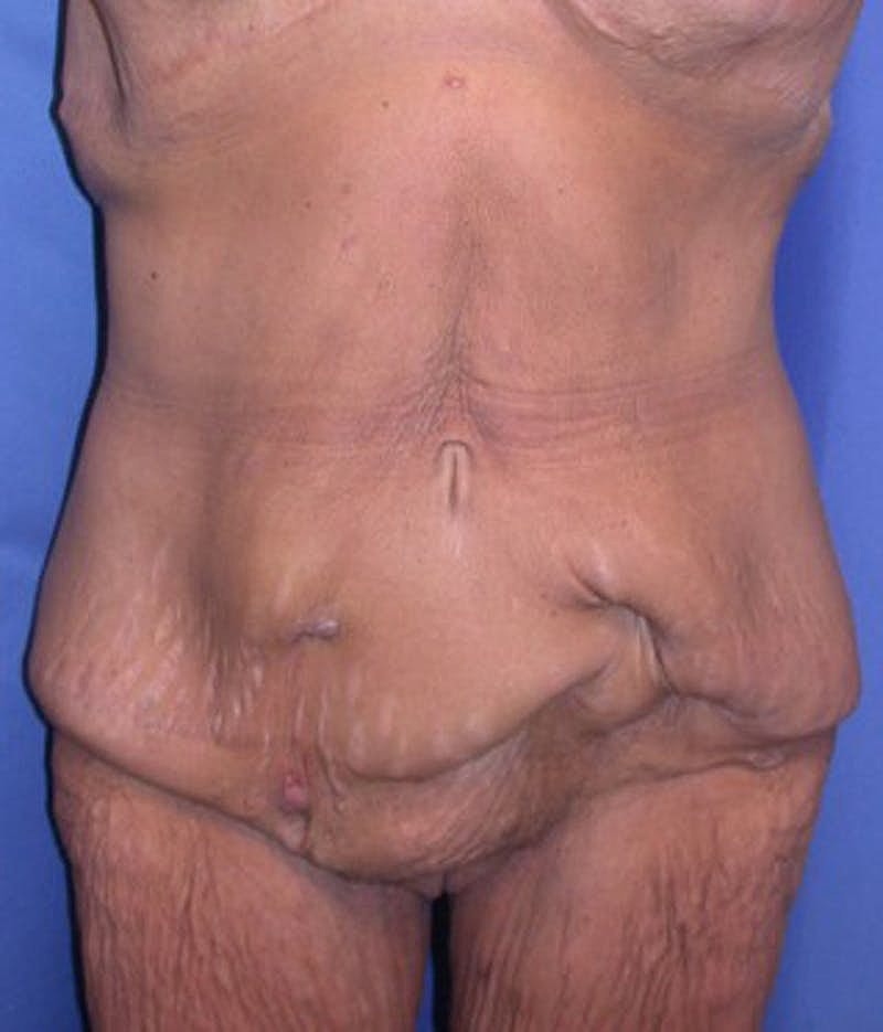 Massive Weight Loss Before & After