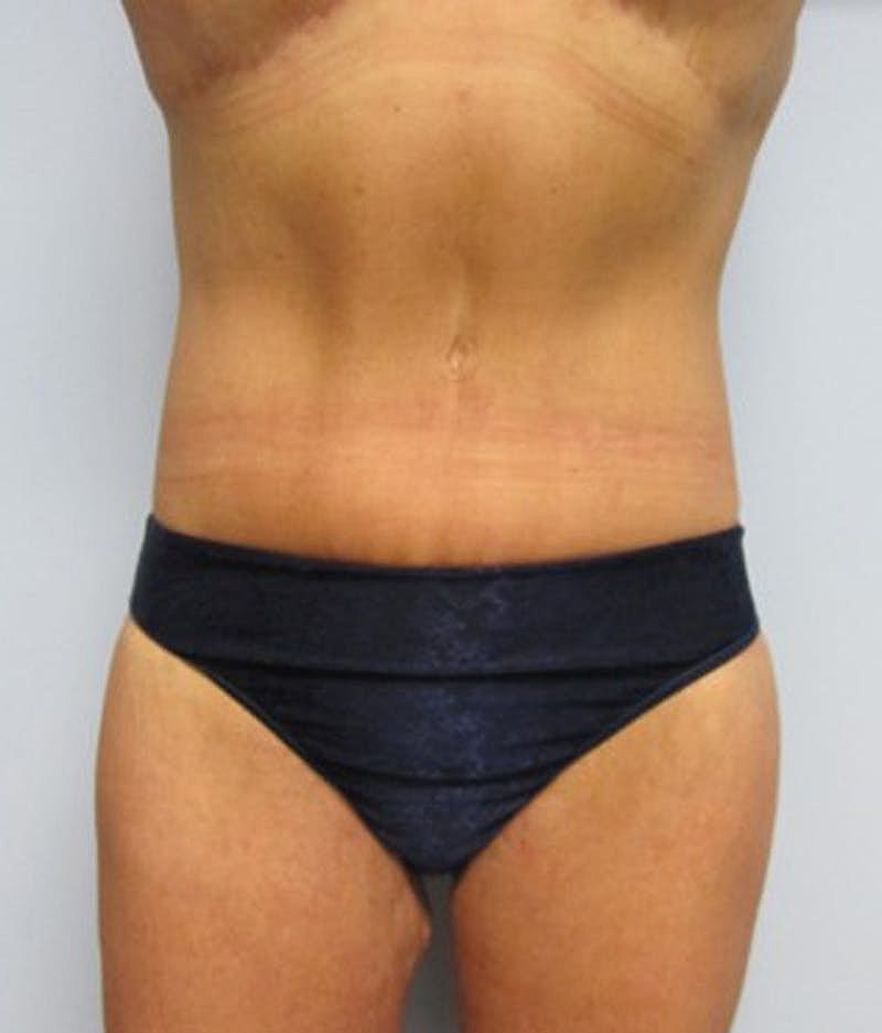 Massive Weight Loss Before & After