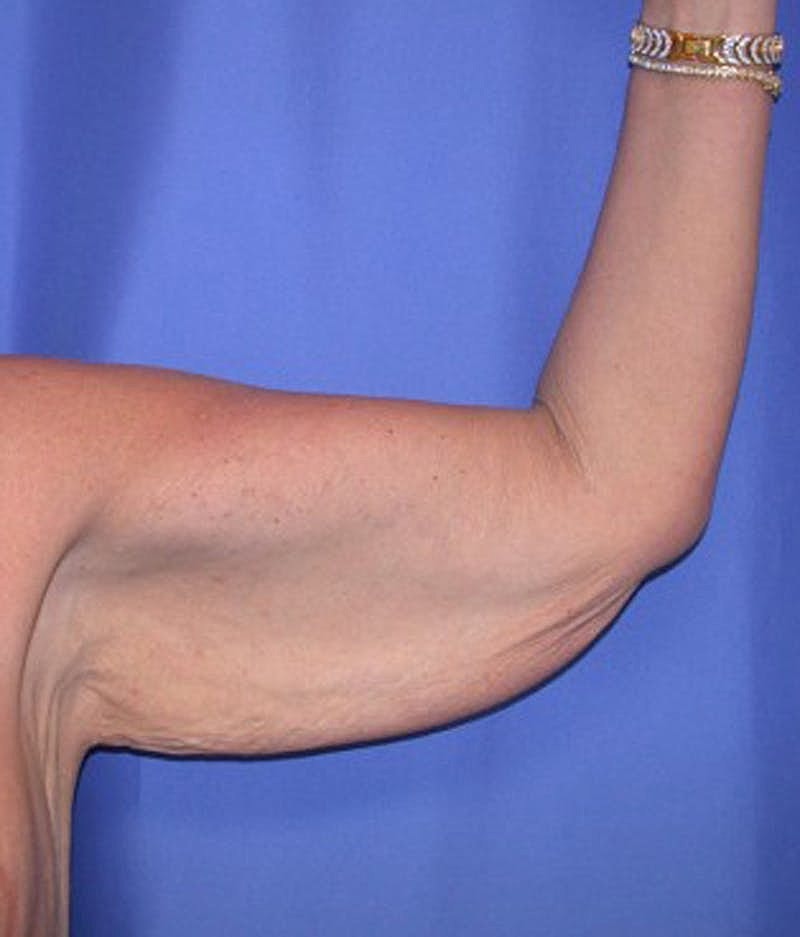 Massive Weight Loss Before & After