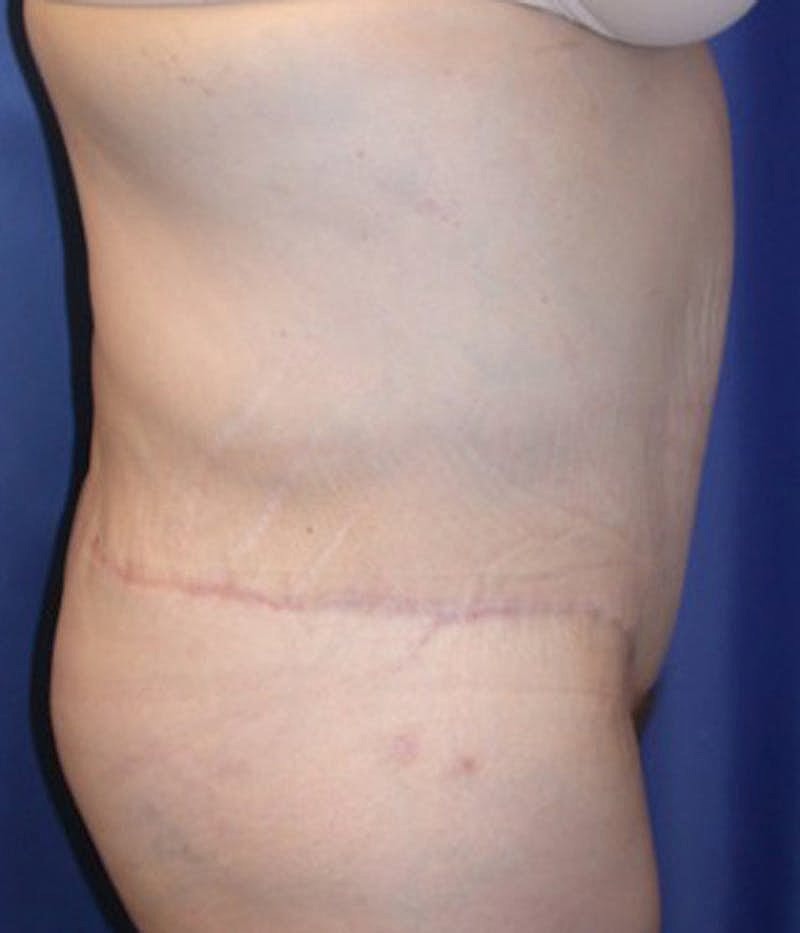 Massive Weight Loss Before & After