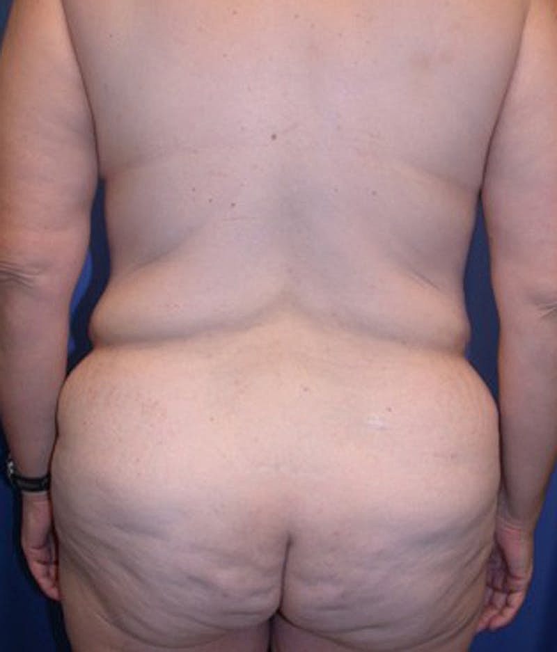 Massive Weight Loss Before & After