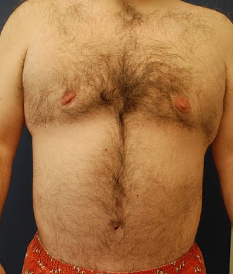 Massive Weight Loss Before & After