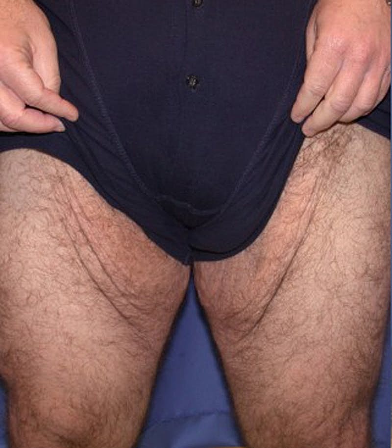 Massive Weight Loss Before & After