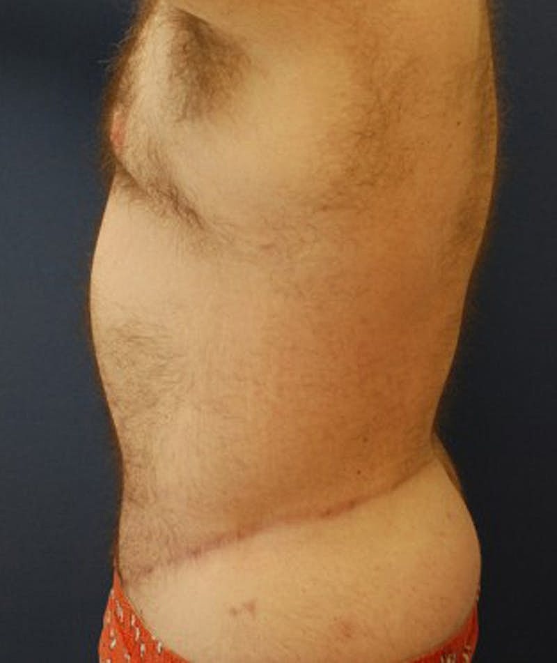 Massive Weight Loss Before & After