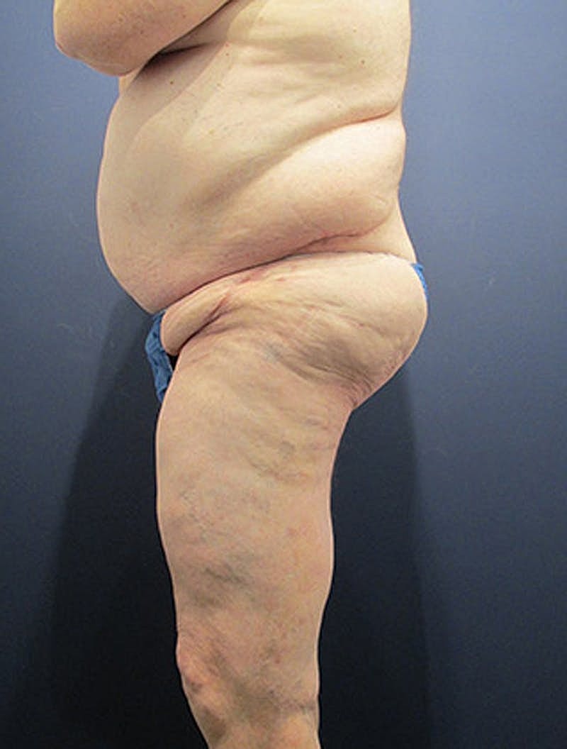 Massive Weight Loss Before & After