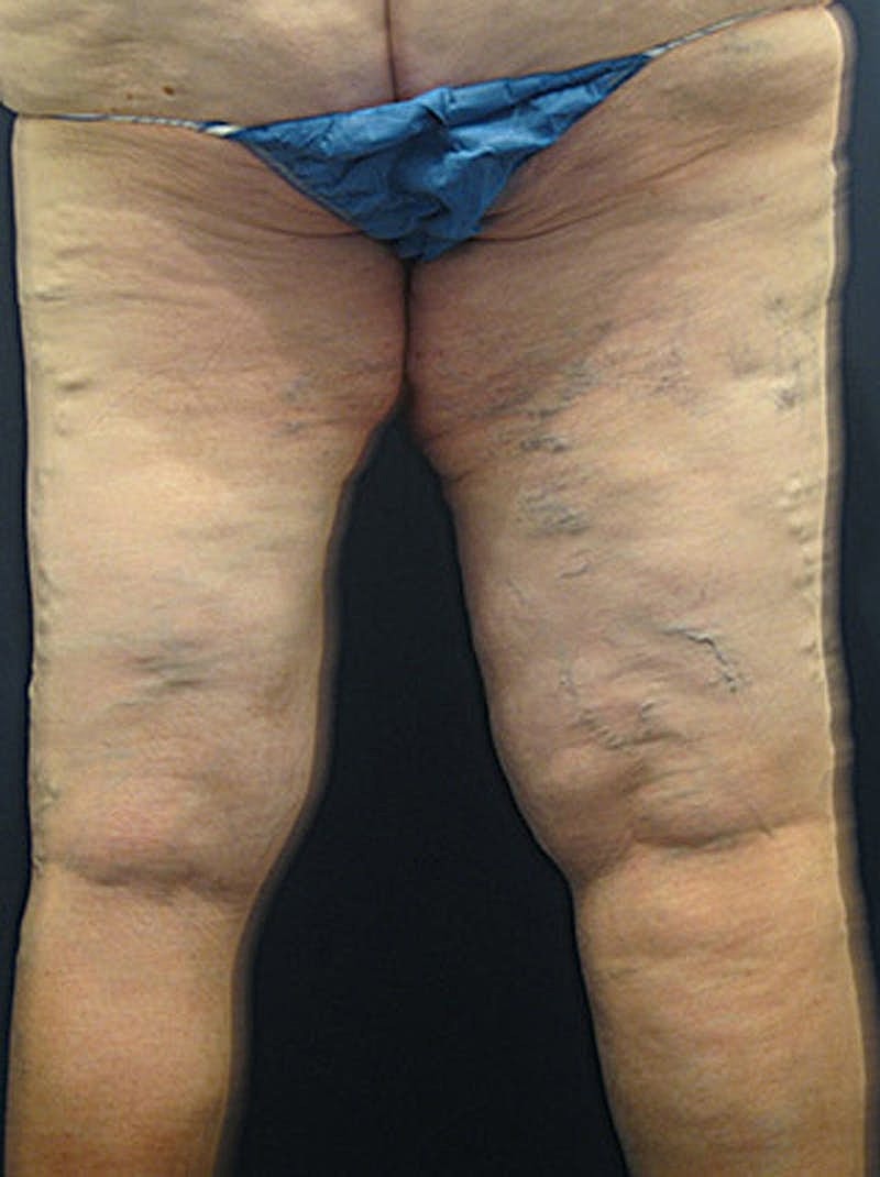 Massive Weight Loss Before & After