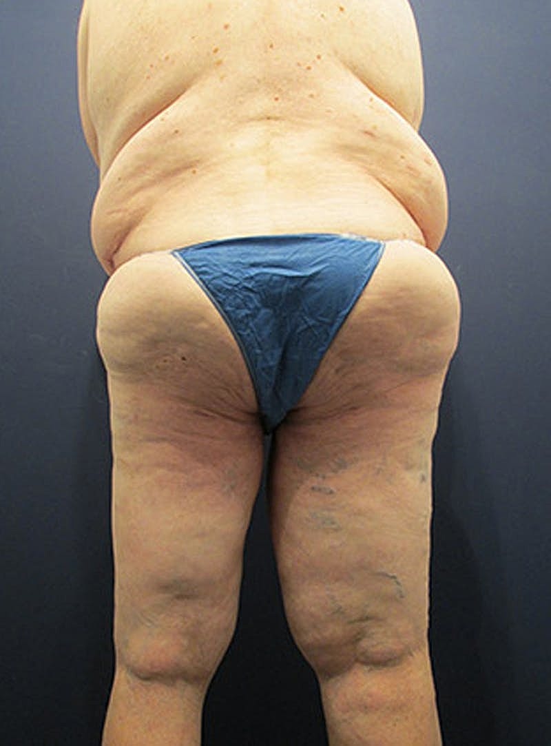 Massive Weight Loss Before & After