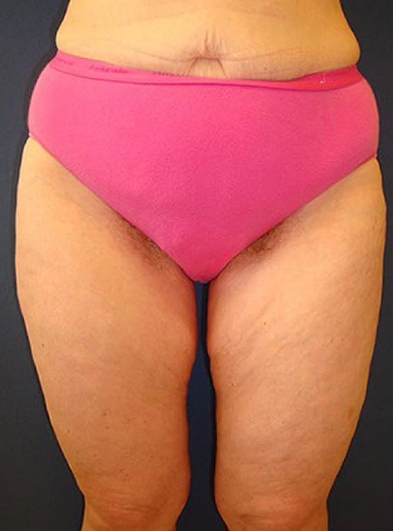 Massive Weight Loss Before & After