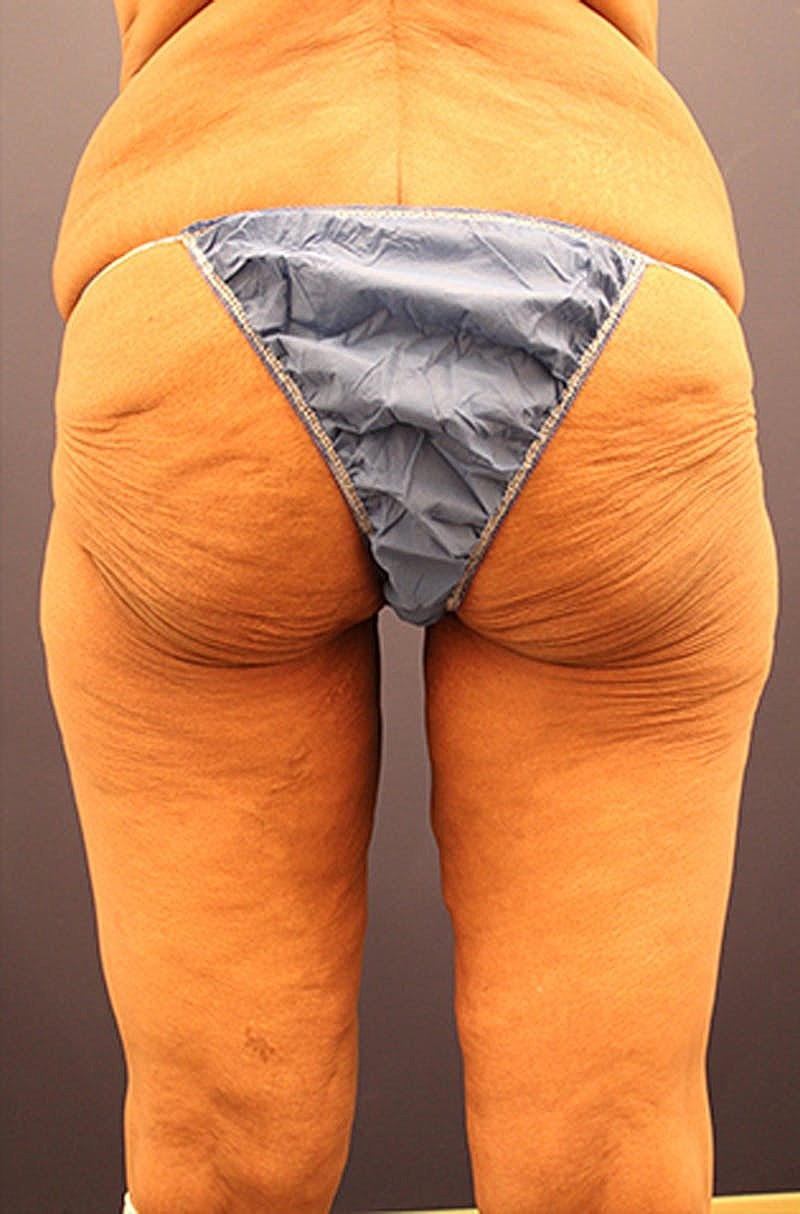 Massive Weight Loss Before & After