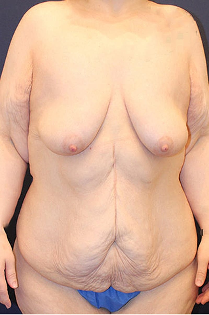 Massive Weight Loss Before & After