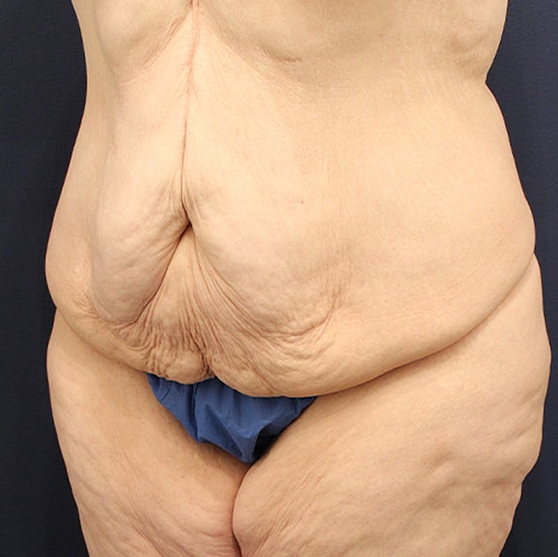 Massive Weight Loss Before & After