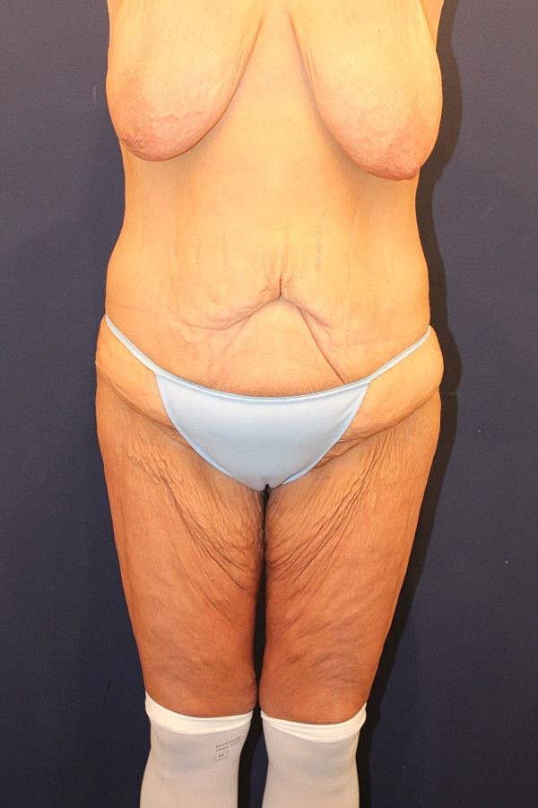 Massive Weight Loss Gallery Before & After