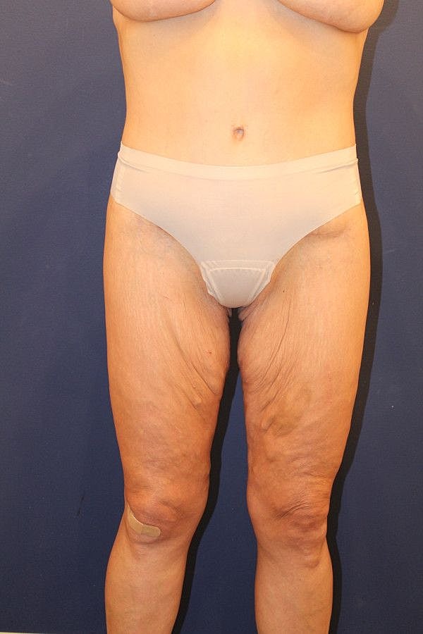 Massive Weight Loss Gallery Before & After