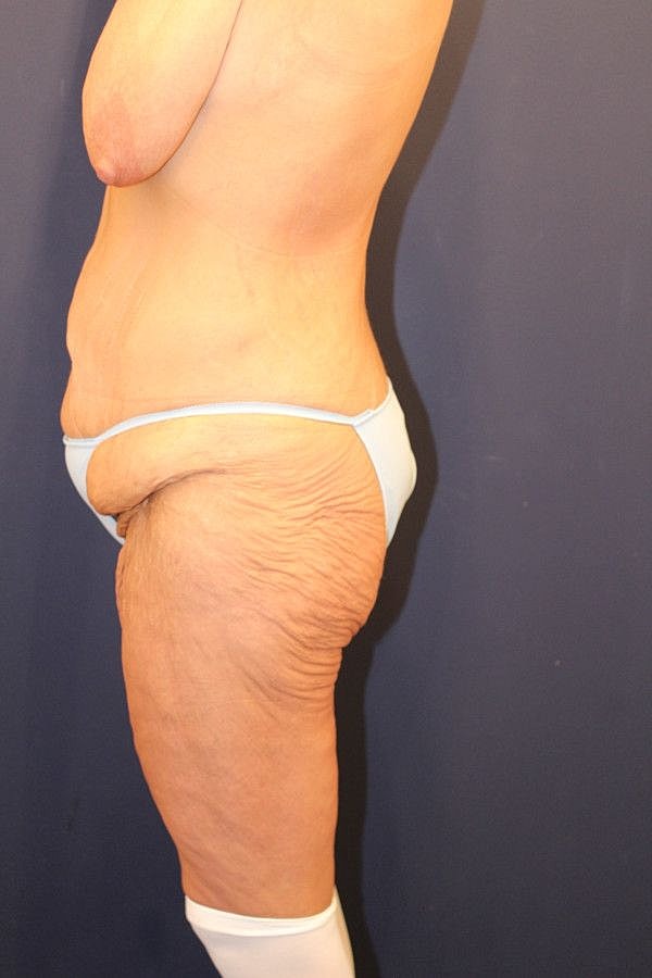 Massive Weight Loss Gallery Before & After