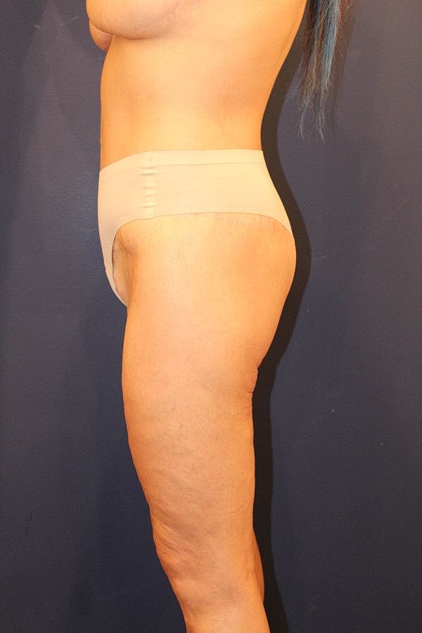 Massive Weight Loss Gallery Before & After