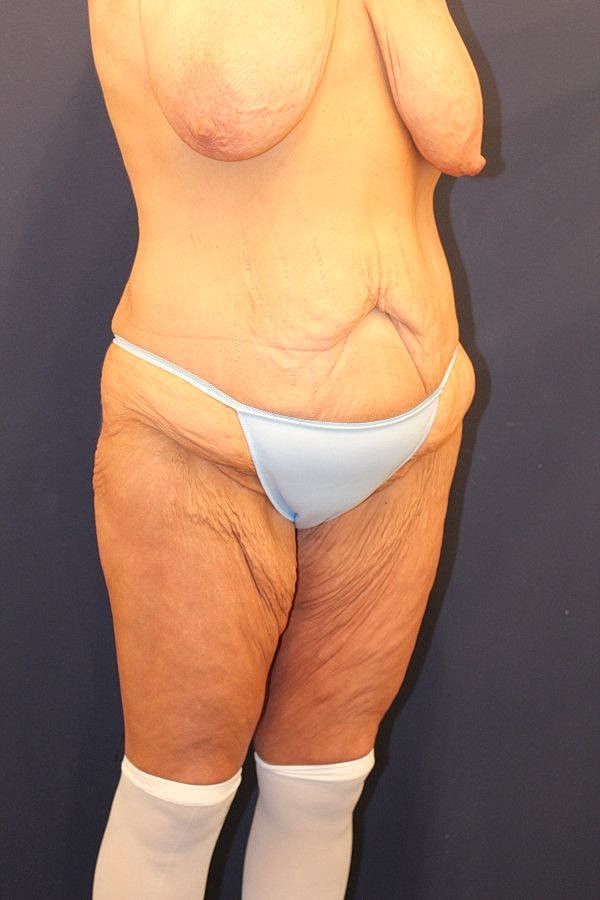 Massive Weight Loss Gallery Before & After