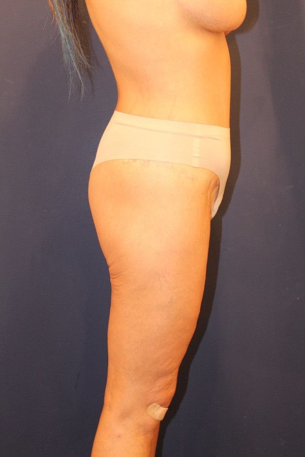 Massive Weight Loss Gallery Before & After
