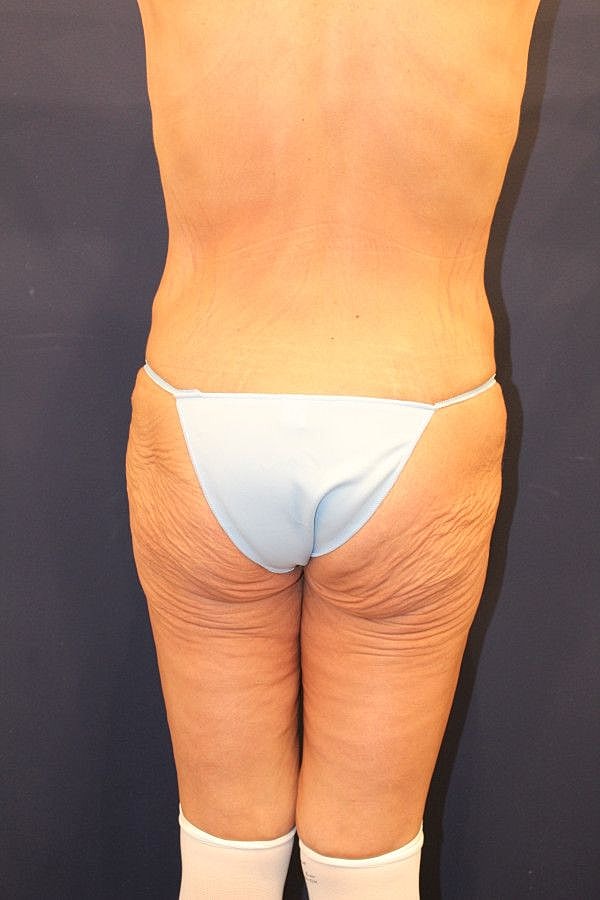 Massive Weight Loss Gallery Before & After