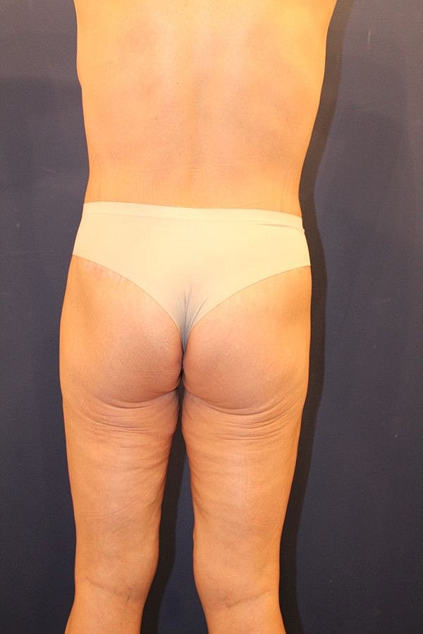 Massive Weight Loss Gallery Before & After