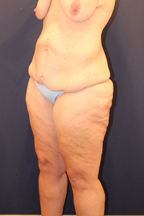 Massive Weight Loss Gallery Before & After