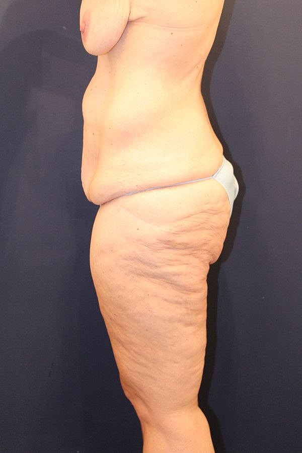 Massive Weight Loss Gallery Before & After
