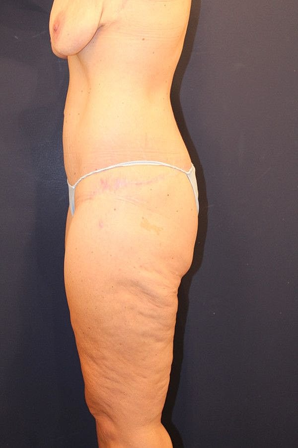 Massive Weight Loss Gallery Before & After