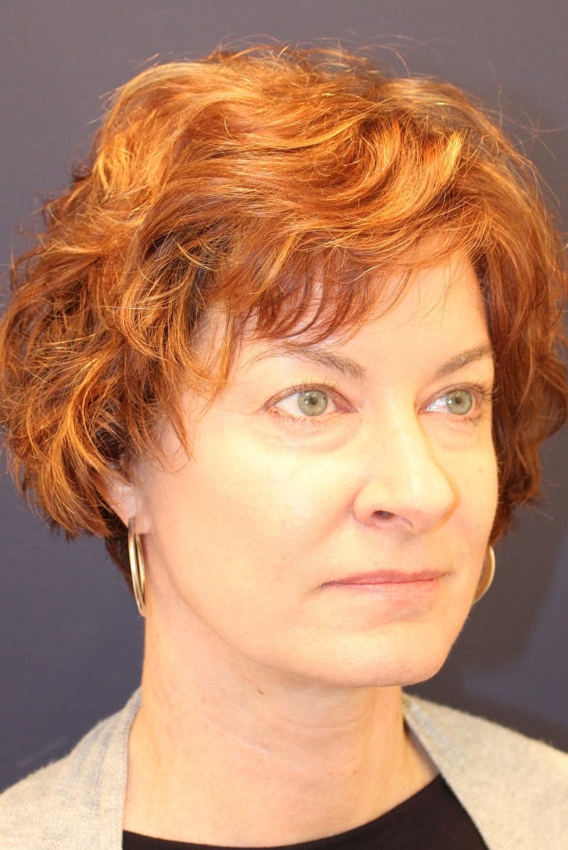 Neck Lift Before & After