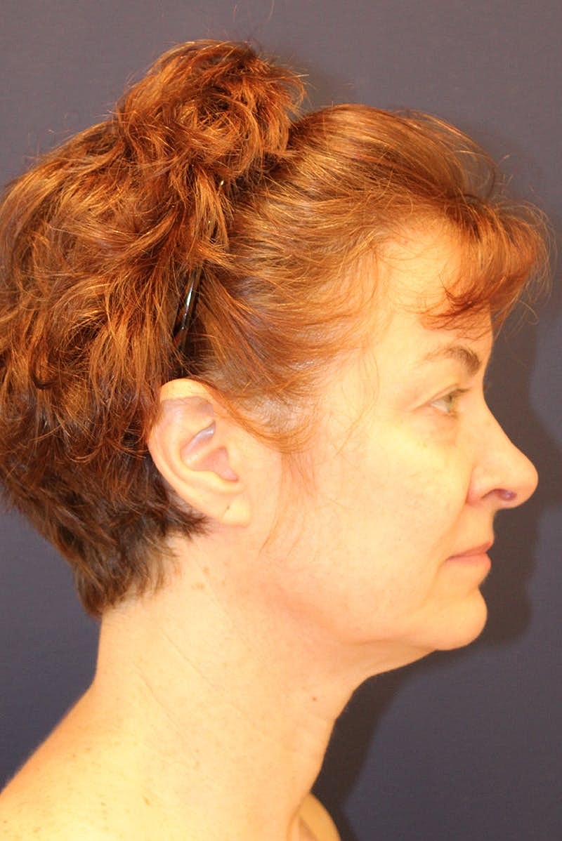 Neck Lift Before & After