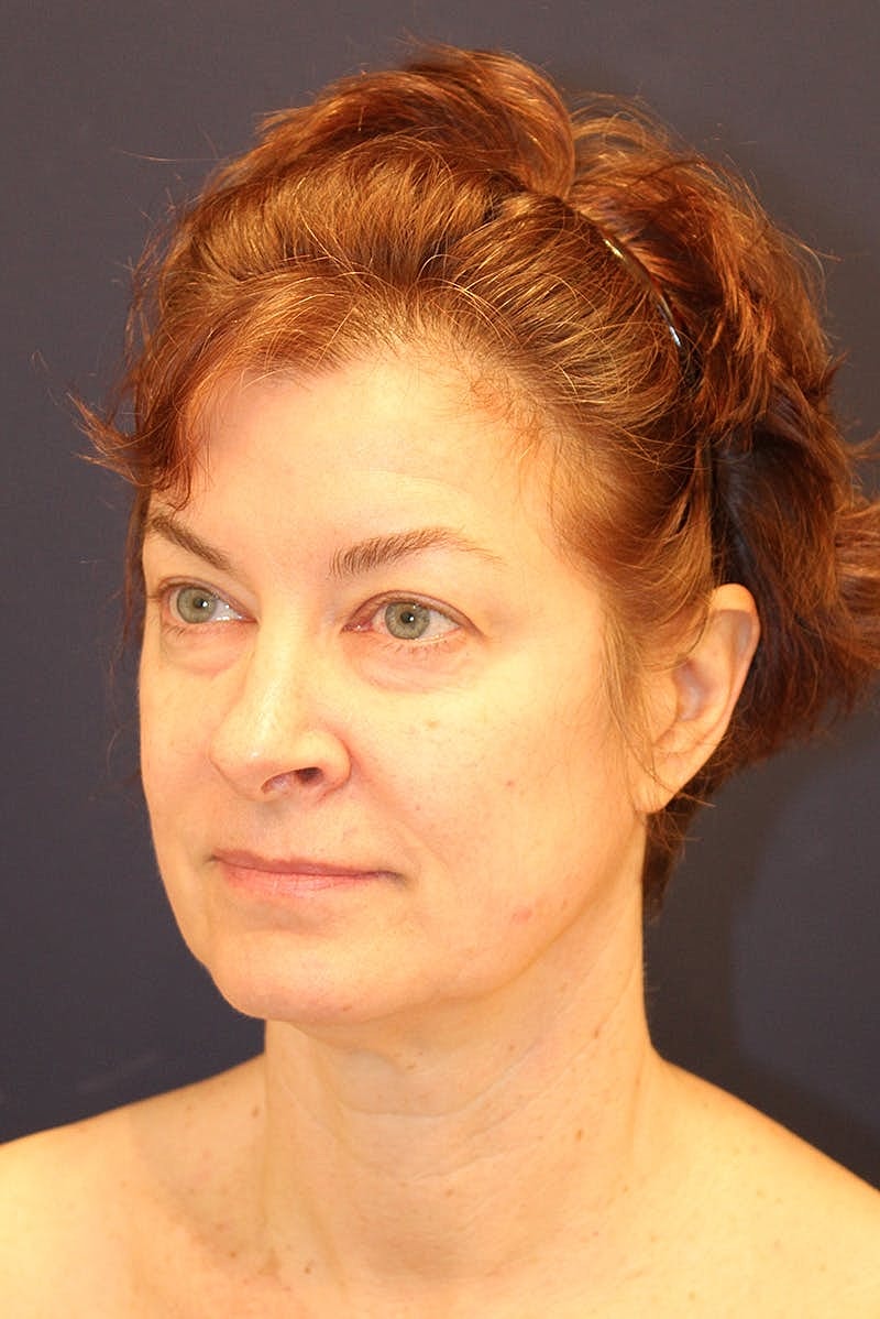 Neck Lift Before & After