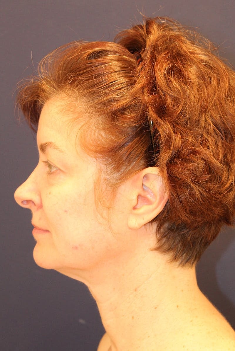 Neck Lift Before & After