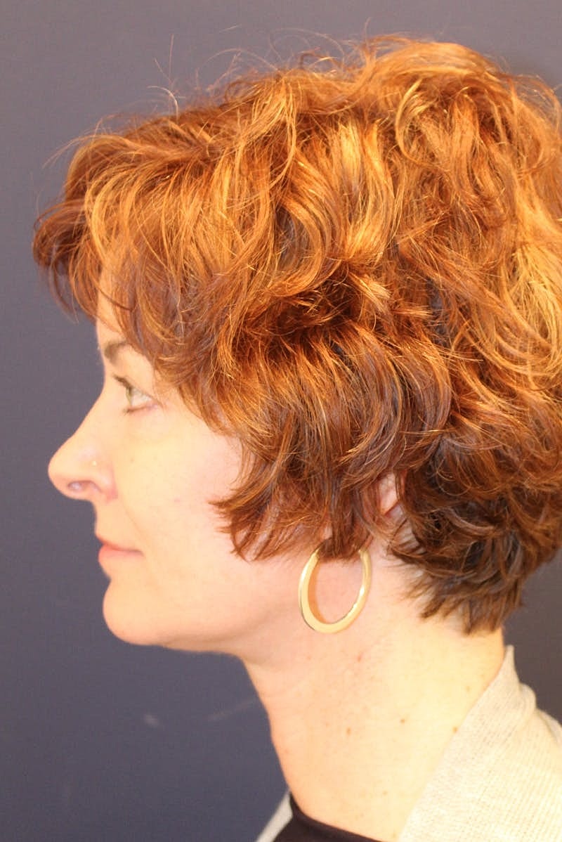 Neck Lift Before & After