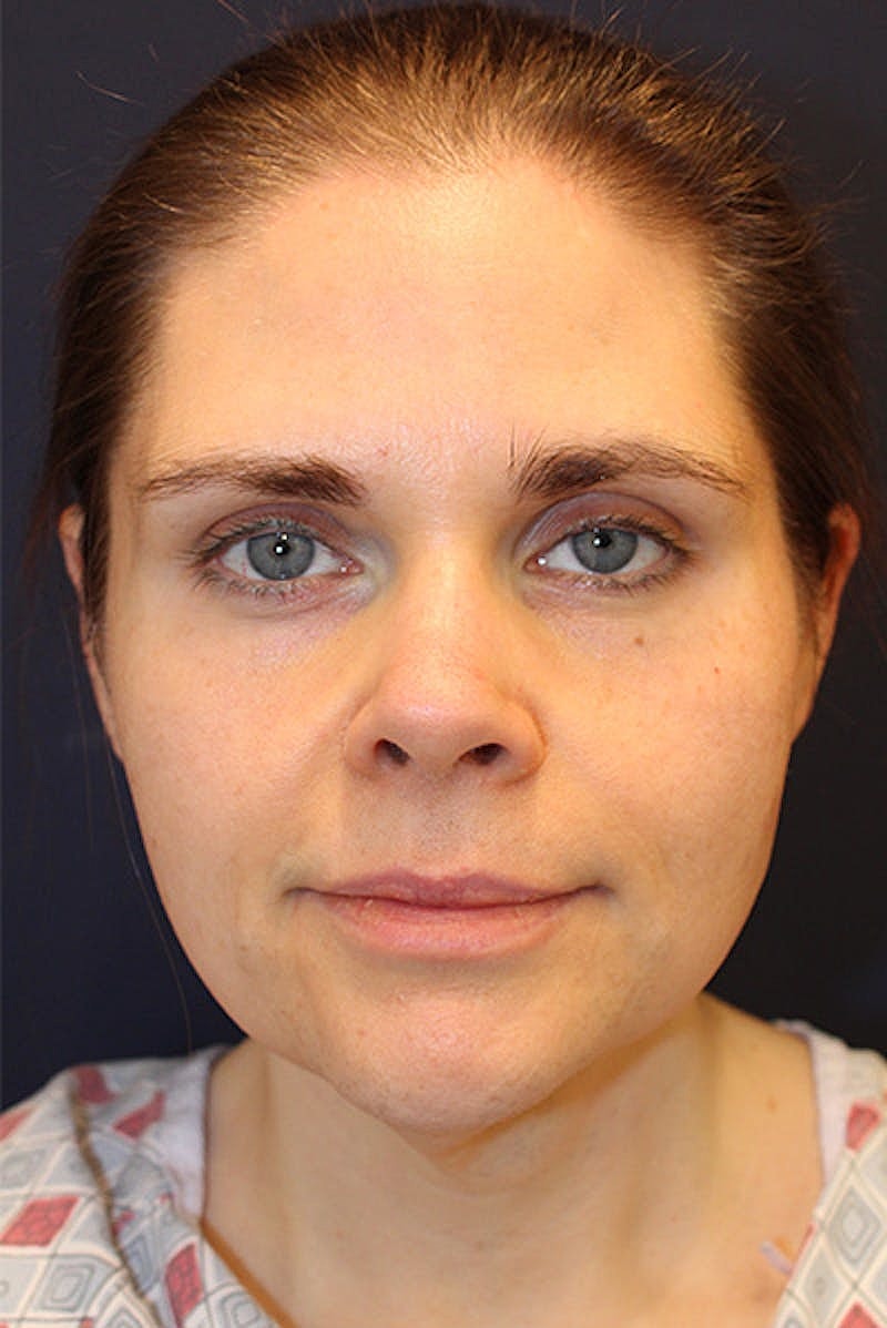 Neck Lift Before & After