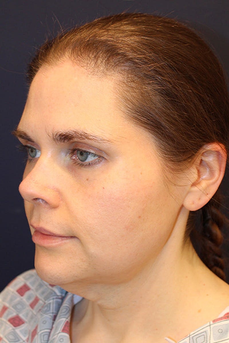 Neck Lift Before & After