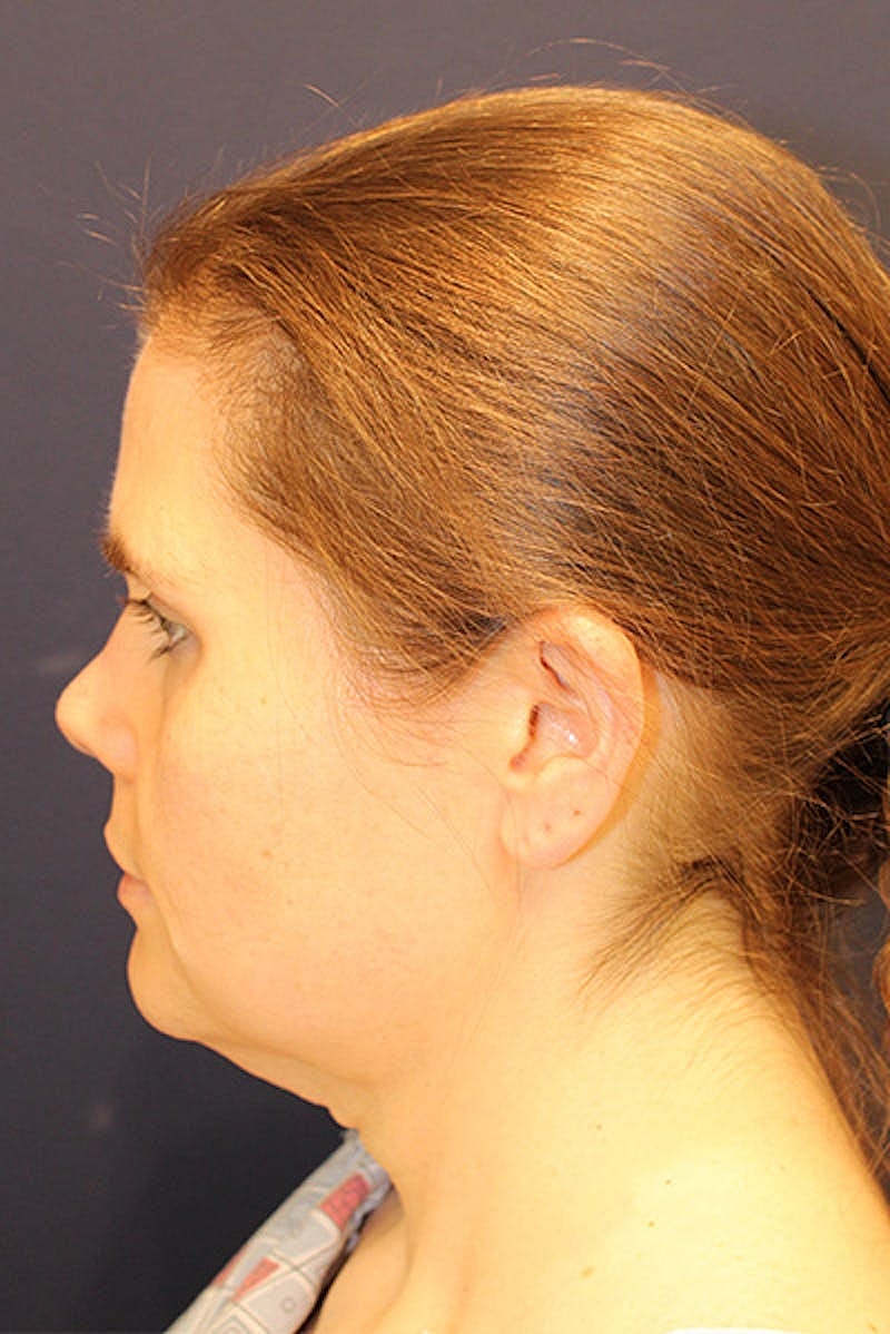 Neck Lift Before & After