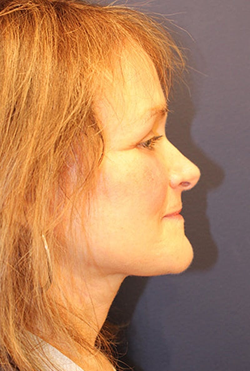 Neck Lift Before & After