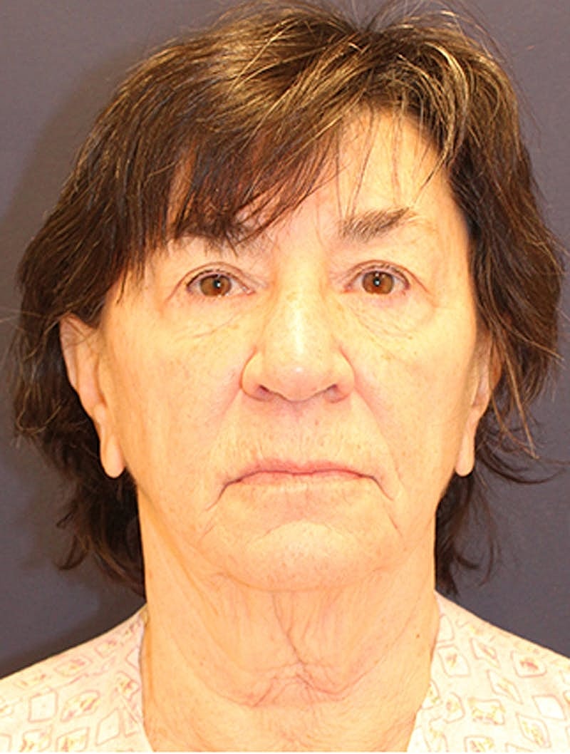 Neck Lift Before & After