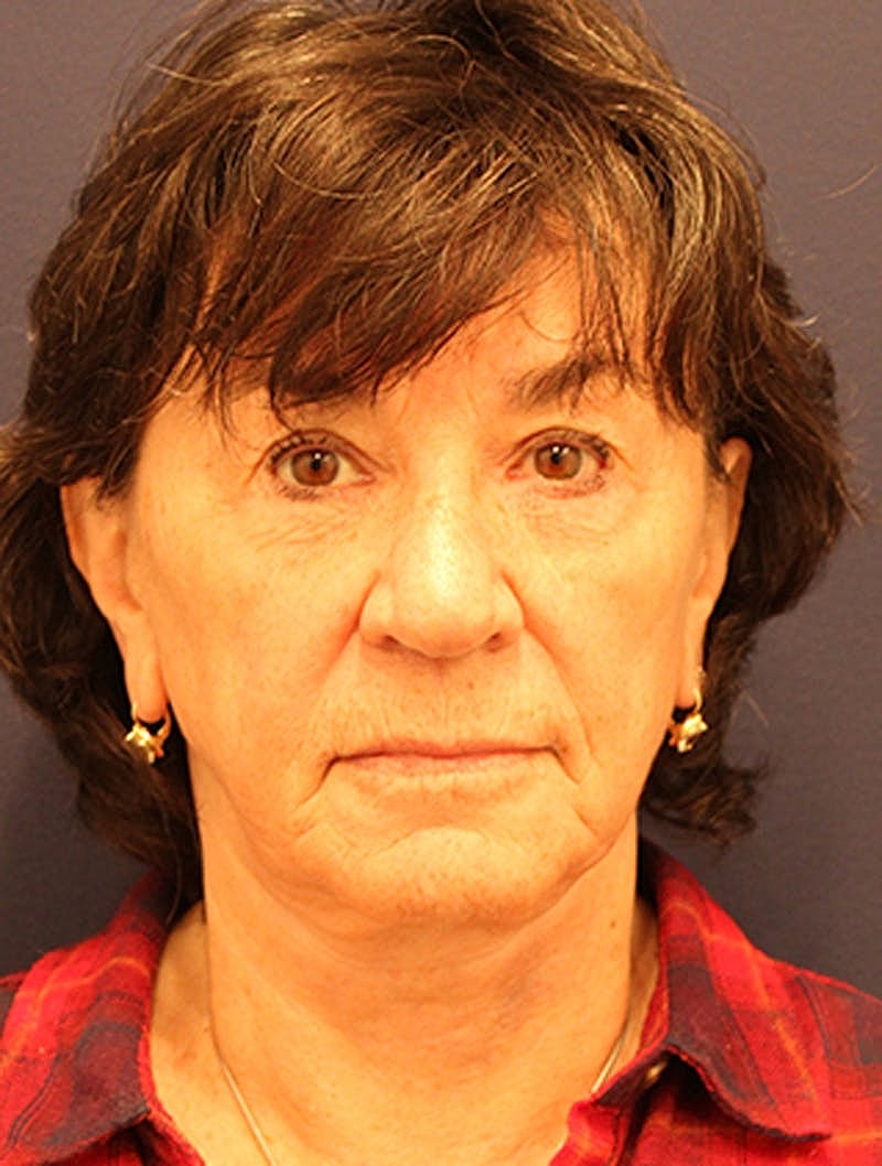 Neck Lift Before & After