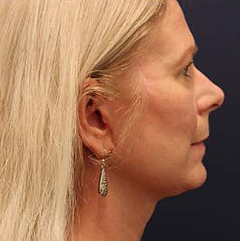 Neck Lift Before & After