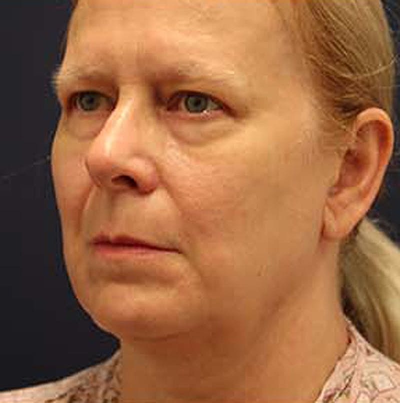 Neck Lift Before & After