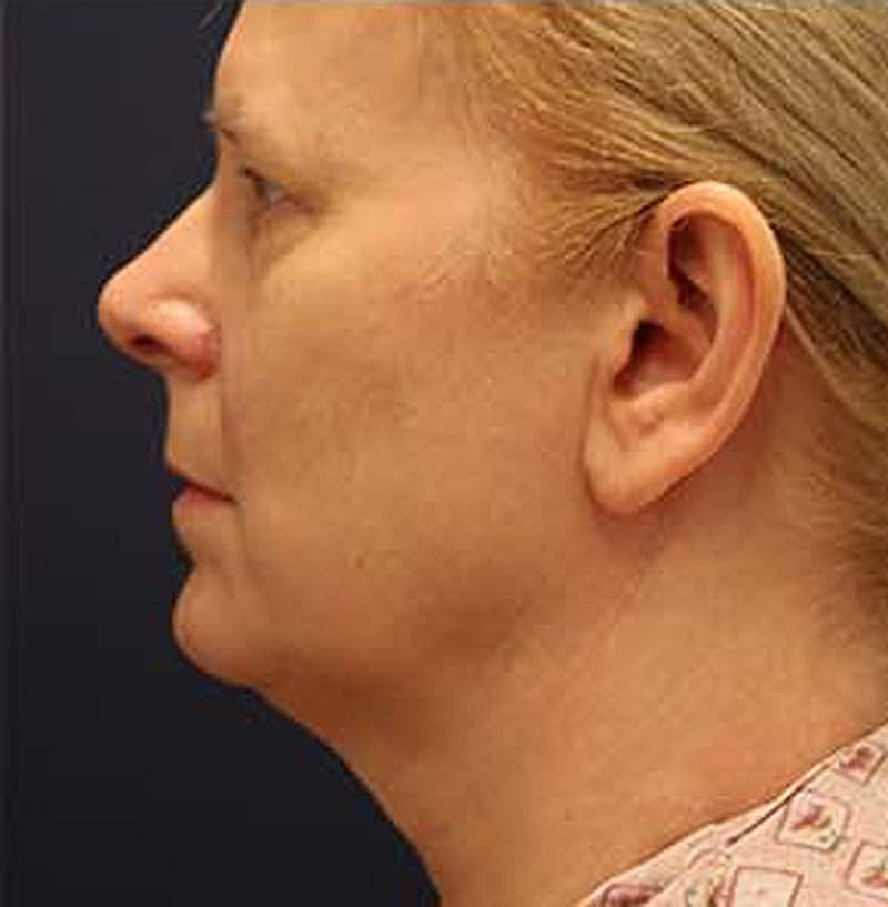 Neck Lift Before & After