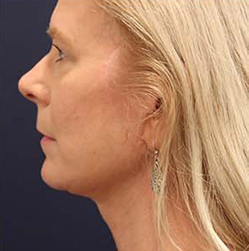 Neck Lift Before & After
