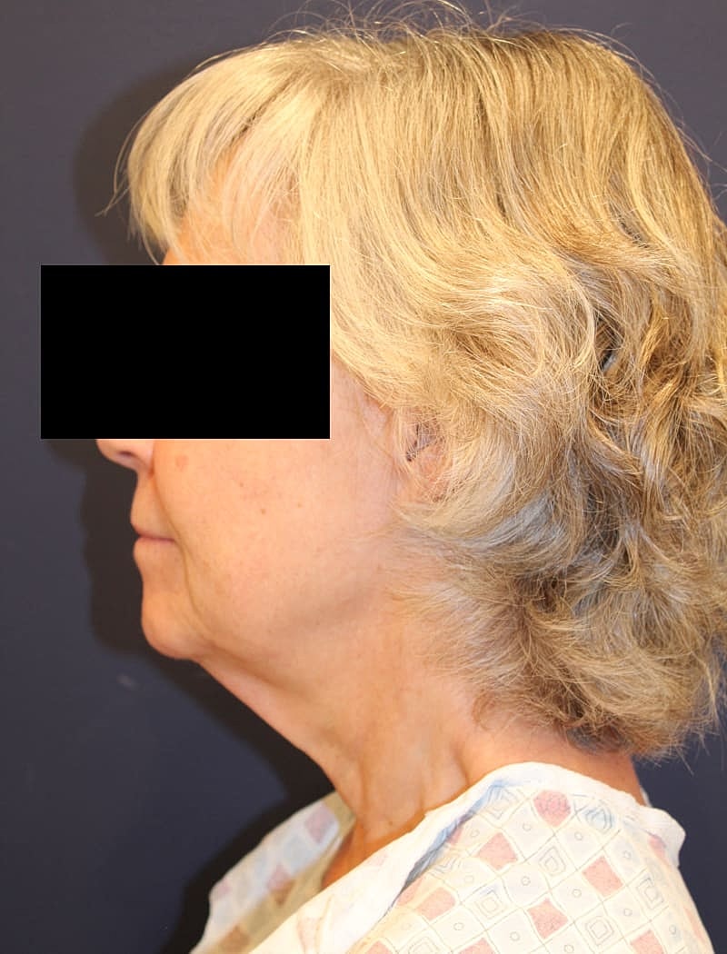Neck Lift Gallery Before & After